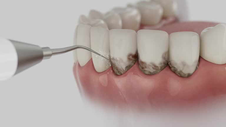 Reliable Dental Implants contractor in Mount Pleasant, TX by Smile Center Dentistry